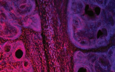 Gene Methylation and Cytological Atypia in Random Fine-Needle Aspirates for Assessment of Breast Cancer Risk.